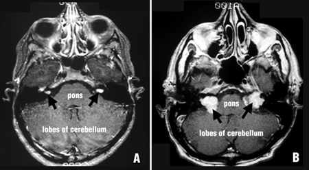 [NF2 Figure 1]